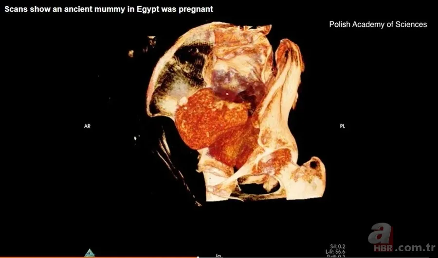 Doğmamış çocuğuyla mumyalandı: 2 bin yıl nasıl bozulmadan kaldı? "Gerçek bir insanlık trajedisi" 10