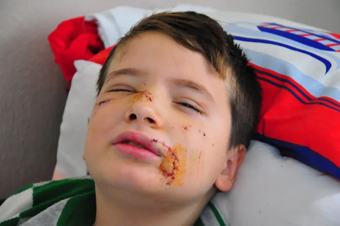 Bir köpek saldırısı haberi daha! 8 yaşındaki Mert'in yüzüne 60 dikiş atıldı - 2