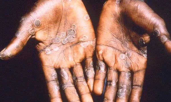 Maymun çiçeği virüsünün belirtileri nelerdir? Ölüm riski düşük ama çok acı çektiriyor | Maymun çiçeğinin iyileşme süreci ne kadar?