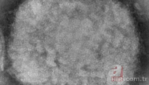 Maymun çiçek virüsü yeni salgına davetiye çıkardı! Avrupa’da vaka sayısı artışta, tedavisi yok 14