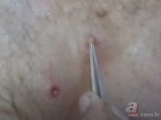 Sırtındaki yarayı sivilce zannetti ama gerçek dehşete düşürdü! Bakın içinden ne çıktı 25