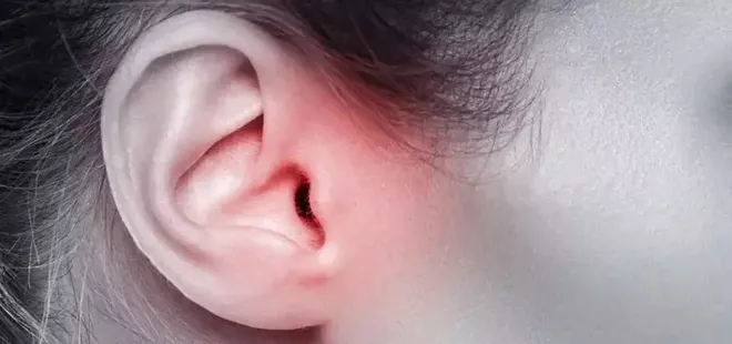 Orta kulak iltihabı tedavi edilmezse yüz felci yapabiliyor!