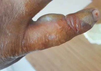 Bursa'da kendisini ısıran yılanla birlikte hastaneye koştu🐍 Ölümle yaşam arasında mücadele