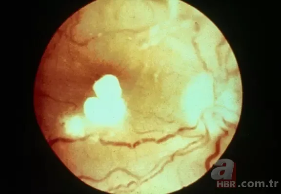 Sabah bir bardak suya tükürün! Tükürüğünüz suyun yüzeyinde kalmıyorsa… 18