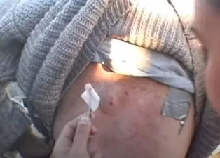Sırtındaki yarayı sivilce zannetti ama gerçek dehşete düşürdü! Bakın içinden ne çıktı