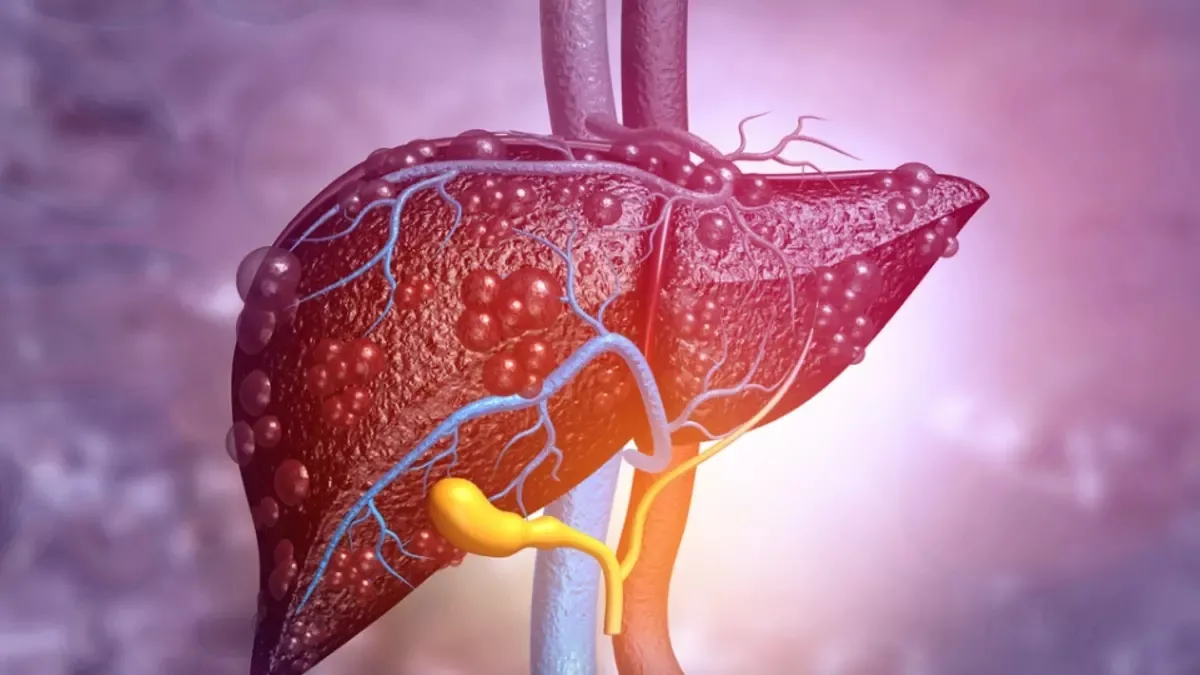 Karaciğer yetmezliği yılda 2 milyondan fazla ölüme sebep oluyor