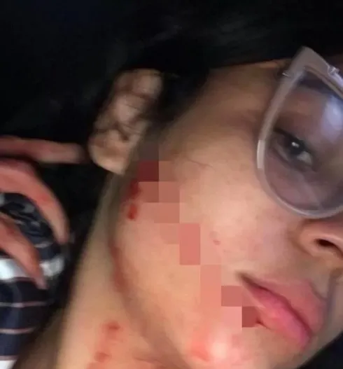 sosyal-medya-fenomenine-otobus-yolculugu-eziyet-oldu-sebepsiz-yere-suratina-kesik-atildi-agzindan-kulagina-kad-1670418512405.jpg Sosyal medya fenomenine otobüs yolculuğu eziyet oldu! Sebepsiz yere suratına KESİK ATILDI! Ağzından kulağına kadar dikiş atıldı - 2