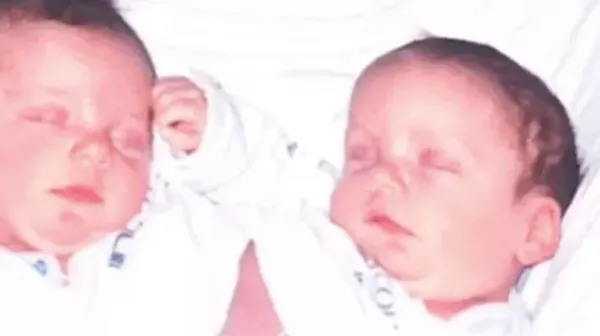 Kaybettiği yapışık ikizinin hayalini gerçekleştirdi! Hikayeleri Yürek bukrtu