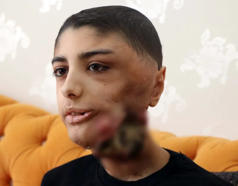 Çenesinin altına kadar indi! Yüzündeki yara her geçen gün büyüyor