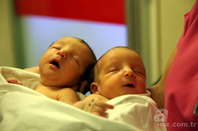 Yapışık ikizler dünyaya geldi 10