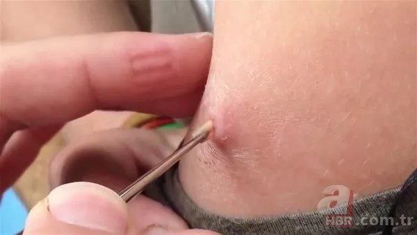 Kolundaki sivilceden böcek çıktı 👩⚕️ Doktora gidince şoke oldu | Cımbızla çektikçe içi gitti 9
