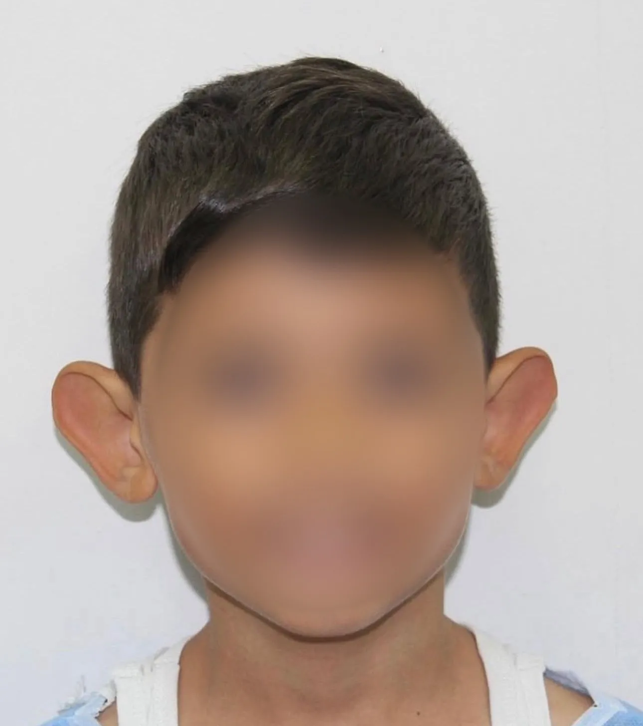 "Kepçe kulak" sorunu çocuklarda özgüveni zedeliyor