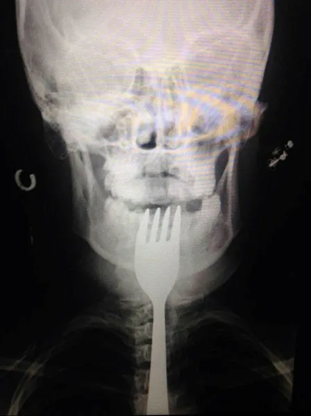 Dişini karıştırdığı çatal boğazına takıldı - 1