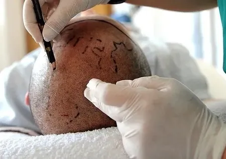 Saç ektirmek için İstanbul'a geldi başına gelmeyen kalmadı!