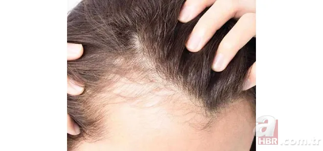 Kaşınan ve kepeklenen saçınız varsa dikkat! Bu yöntemle hem rahatlayacak hem de saçınızı uzatacaksınız 6