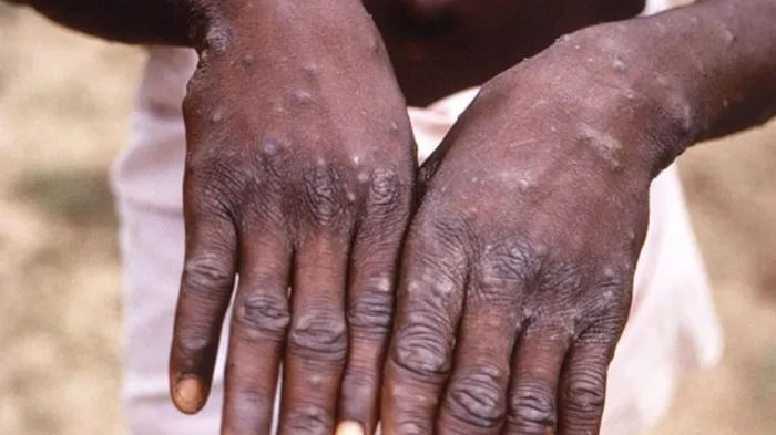 DSÖ’den çarpıcı ’M çiçeği virüsü’ açıklaması: Durdurulabilir | İlk belirtiler ne zaman ortaya çıkıyor?