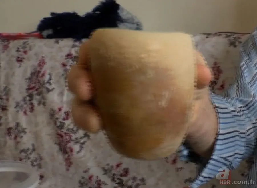 Karın bölgesinde şişlik ve halsizlik şikayetiyle doktora gitti! Karnından çıkanlar şoke etti 18