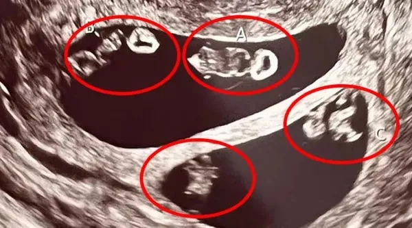 ABD’de şoke eden olay! Ultrasonda ortaya çıktı 70 milyonda bir görülüyor