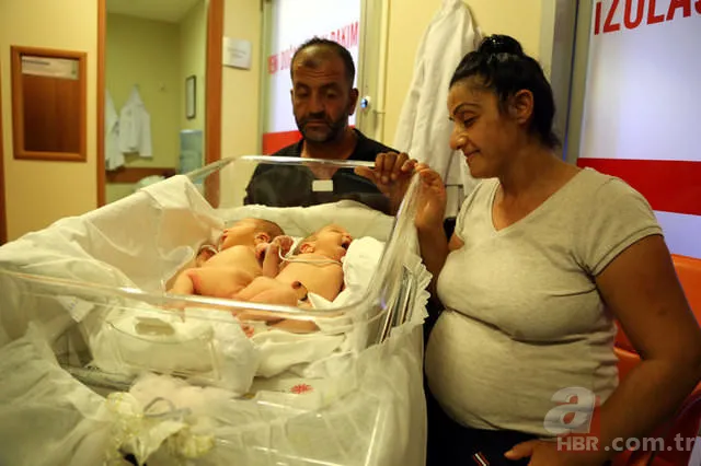 Yapışık ikizler dünyaya geldi 8