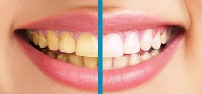 Diş sararmasının 6 nedeni