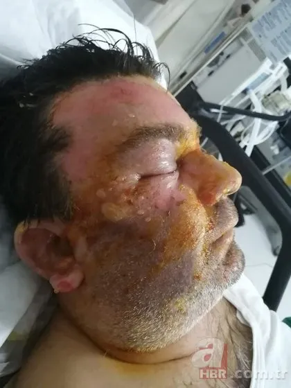 Uyurken hayatı altüst oldu! Kardeşinin yüzüğünü yaktığını söyledi: Ne iyi yaptım, seni yaktım