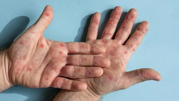 DSÖ’den çarpıcı ’M çiçeği virüsü’ açıklaması: Durdurulabilir | İlk belirtiler ne zaman ortaya çıkıyor?