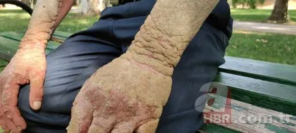 26 yıldır sedef hastalığıyla mücadele ediyor! Görenlerin kaçmasına alışamadı