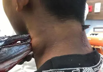 Denizden sıçrayan balık boynuna saplandı!