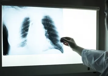 KOAH’ta erken tanı hayat kurtarıyor