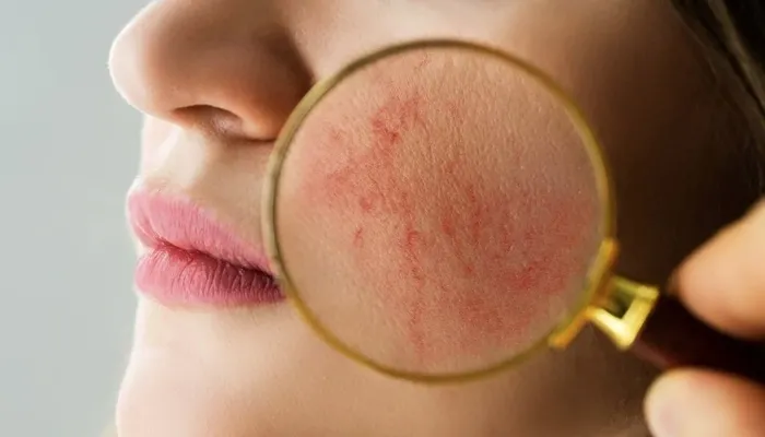 Gül hastalığı nedir? Gül hastalığı belirtileri ve nedenleri...