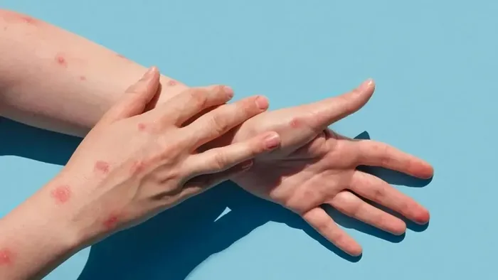 DSÖ’den çarpıcı ’M çiçeği virüsü’ açıklaması: Durdurulabilir | İlk belirtiler ne zaman ortaya çıkıyor?