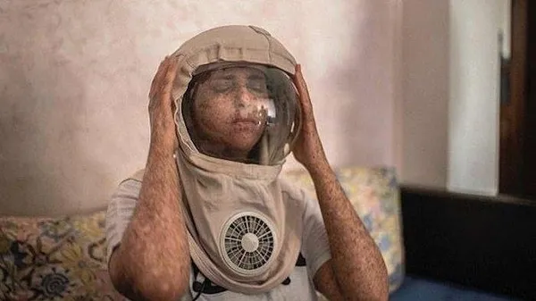 Fatima Ghazaoui, nadir görülen hastalığı yüzünden 20 yıldır gün ışığına çıkmadı | Xeroderma pigmentosum nedir?