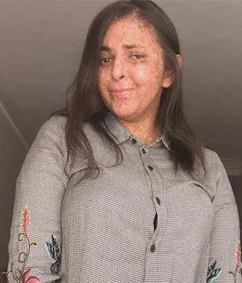 Fatima Ghazaoui, nadir görülen hastalığı yüzünden 20 yıldır gün ışığına çıkmadı | Xeroderma pigmentosum nedir?