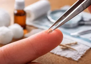 Küçük ama riskli! Kıymık çıkarırken dikkat etmeniz gerekenler