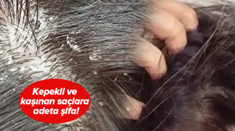 Kaşınan ve kepeklenen saçınız varsa dikkat! Bu yöntemle hem rahatlayacak hem de saçınızı uzatacaksınız