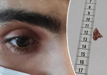 İhmal hayatını kararttı! 1 ay gözünde cam parçasıyla yaşadı