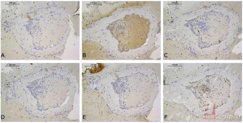 Felç riski COVID-19 aşısıyla artıyor mu? 100 binden fazla kişide görüldü: 17 ay hücrelerde birikerek... 3