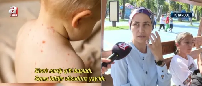 cocuklarin-kabusu-el-ve-ayak-hastaligi-en-net-belirtisi-ates-ve-vucuttaki-dokuntuler-1728762353878.jpg Çocukların kabusu 'el ve ayak hastalığı'! En net belirtisi ateş ve vücuttaki döküntüler - 2