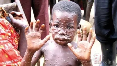 Maymun çiçeği hastalığı nedir?