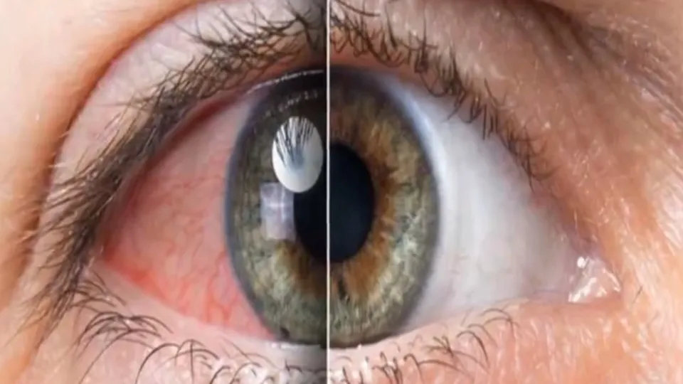 Gözlerinizde kızarıklık varsa dikkat ­| Konjonktivit nedir? | Konjonktivit olanlar nelere dikkat etmeli?