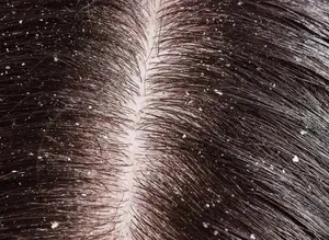 Kepek sorununa çözüm Çinlilerden geldi! Deneyen tamamen kurtuluyor...