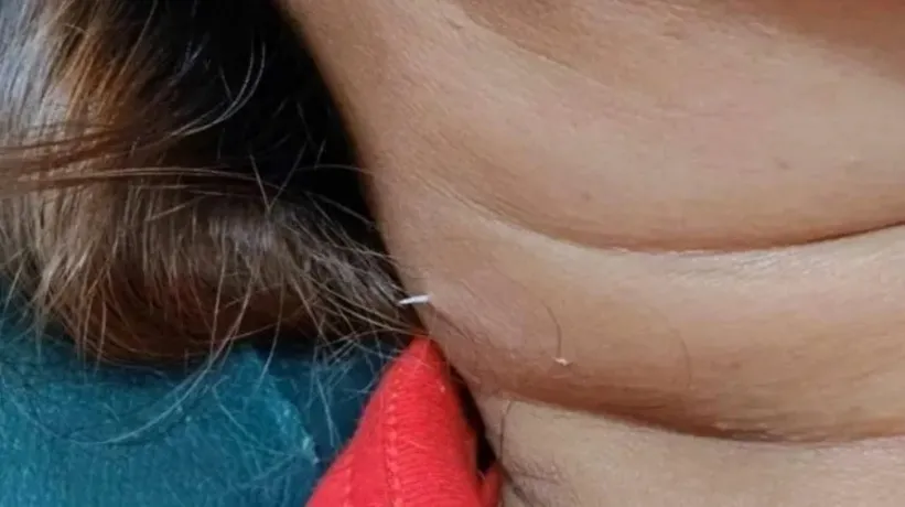 Yuttuğu balık kılçığı boynunu delip dışarı çıktı! Duyanları şaşkına çeviren olay