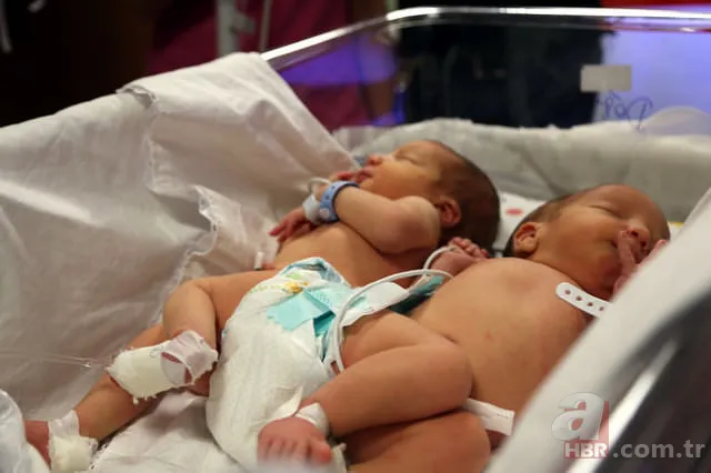 Yapışık ikizler dünyaya geldi 5