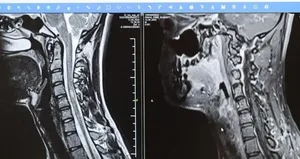 MS hastalığında erken teşhis hayat kalitesini arttırıyor