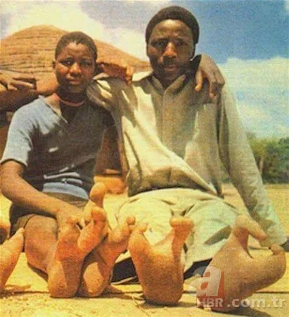 Dünyanın en tuhaf hastalıkları 21