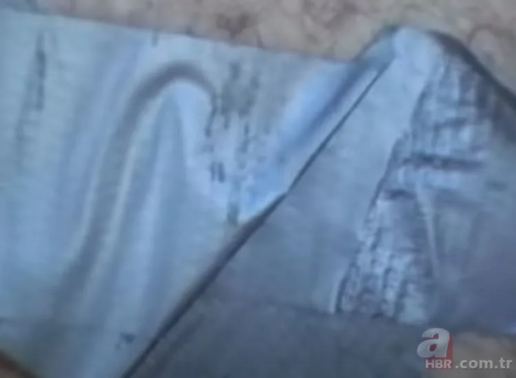 Sırtındaki yarayı sivilce zannetti ama gerçek dehşete düşürdü! Bakın içinden ne çıktı 13