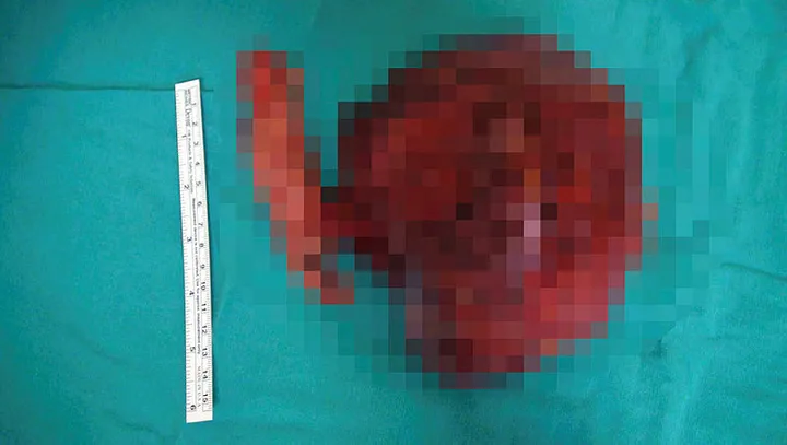 14 yaşındaki çocuğun karnından 1,5 kilogram ur çıktı - 1