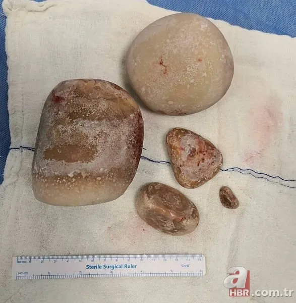 Karın bölgesinde şişlik ve halsizlik şikayetiyle doktora gitti! Karnından çıkanlar şoke etti 9