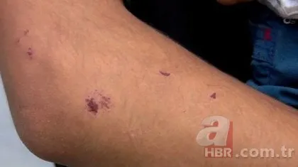 İstanbul’da ‘Aedes’ alarmı! Hastane başvuruları arttı