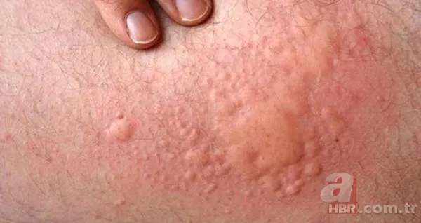 Kurdeşen dökmek ne demek? Kurdeşen (ürtiker) nedir, neden olur, sebepleri neler? Tedavisi var mı, ne iyi gelir? 3